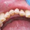 Incisal Bonding Before